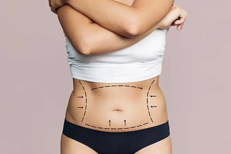 Lipoabdominoplastia 1