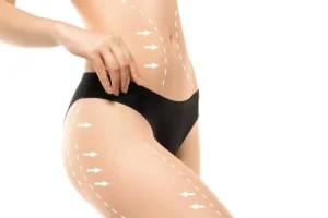 Lipoescultura — remodelado corporal
