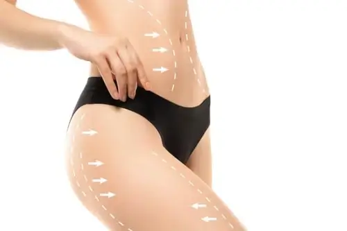 Lipoescultura 1