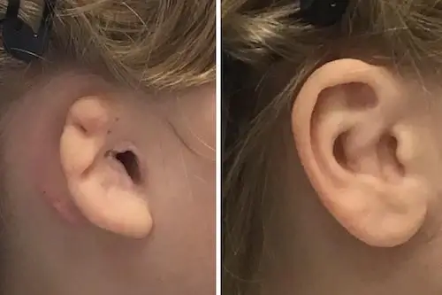 Microtia 1