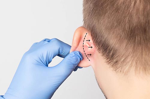 Otoplastia
